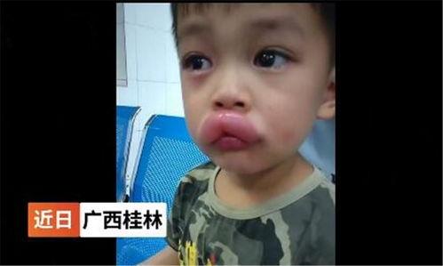 吃瓜过敏嘴红,揭秘过敏背后的真相  第2张