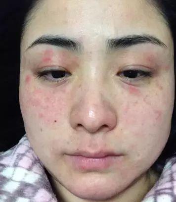 吃瓜过敏嘴红,揭秘过敏背后的真相  第3张